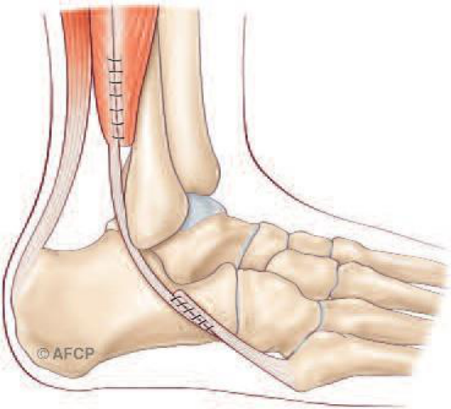 Tendons fibulaires — illustration 3