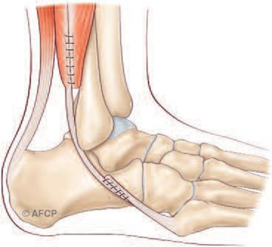 Tendons fibulaires — illustration 3