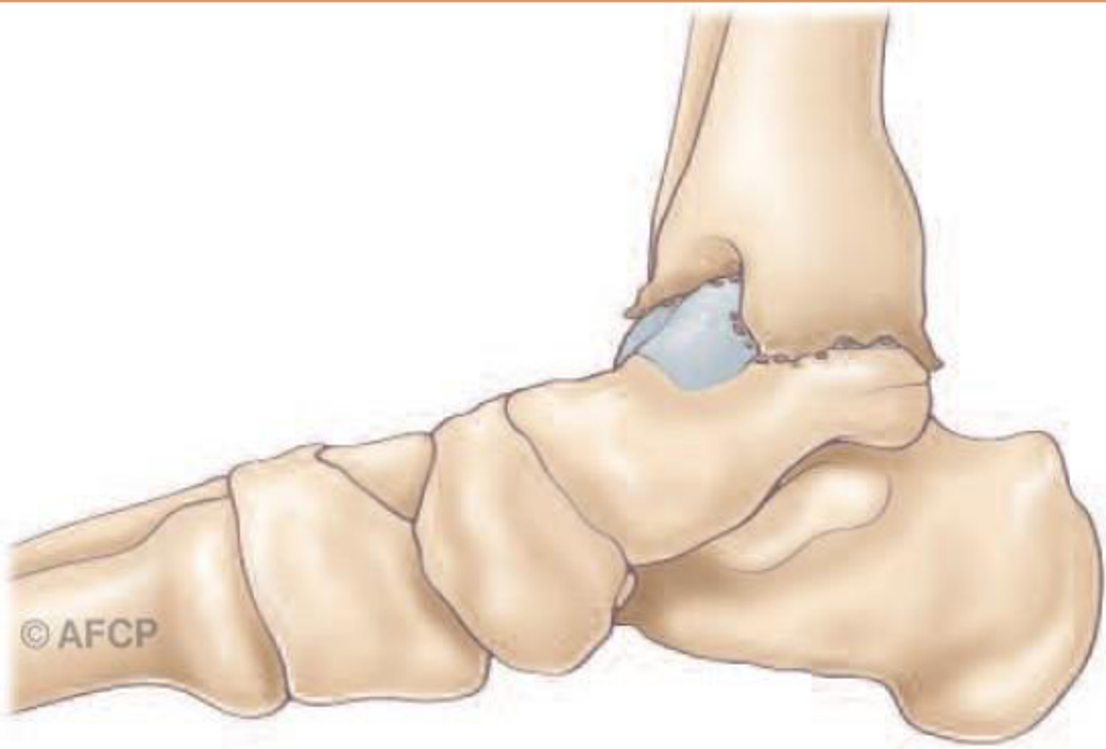 Arthrodèse de cheville — illustration 3