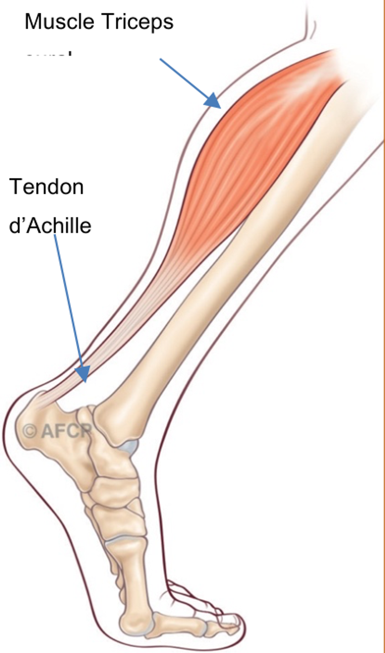 Haglund — illustration 1