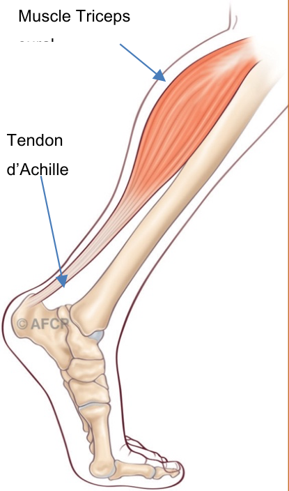 Haglund — illustration 1