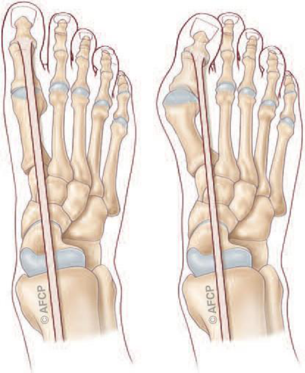 Hallux valgus — illustration 2