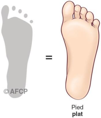 Pied creux — illustration 4