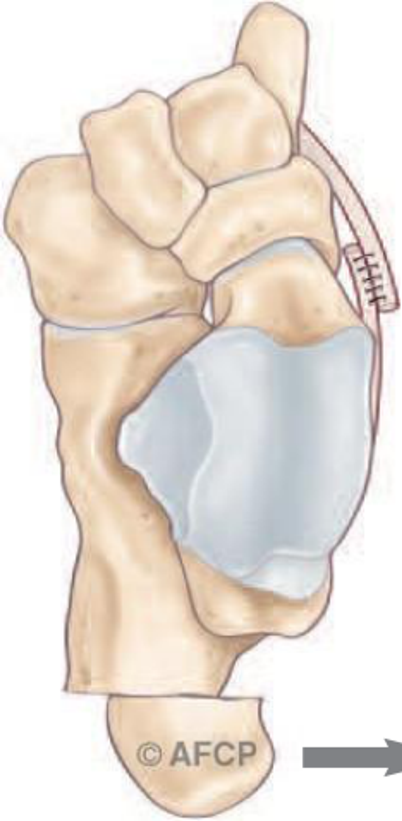 Pied plat — illustration 3