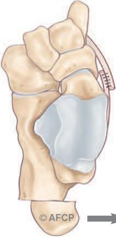 Pied plat — illustration 3