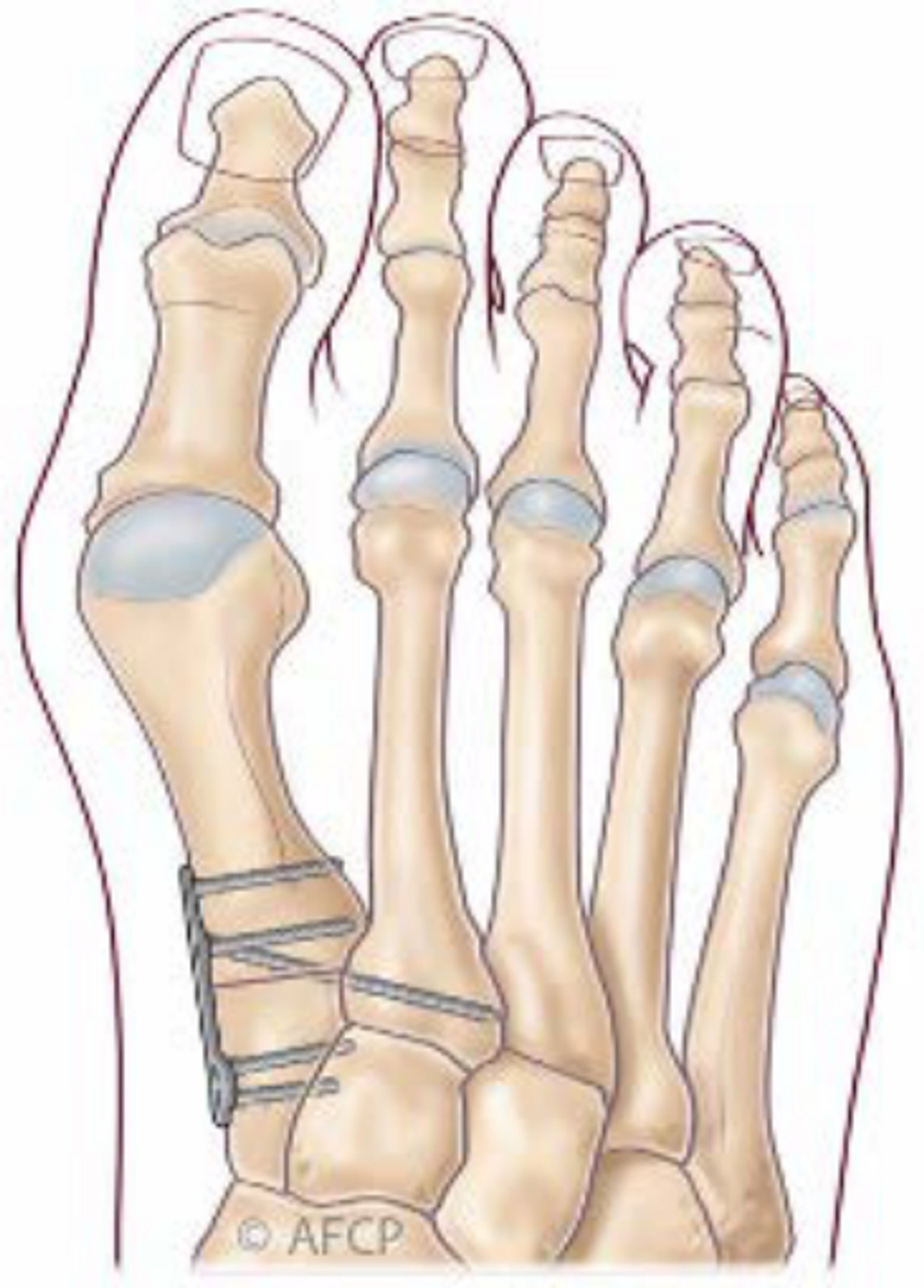 Hallux valgus — illustration 6