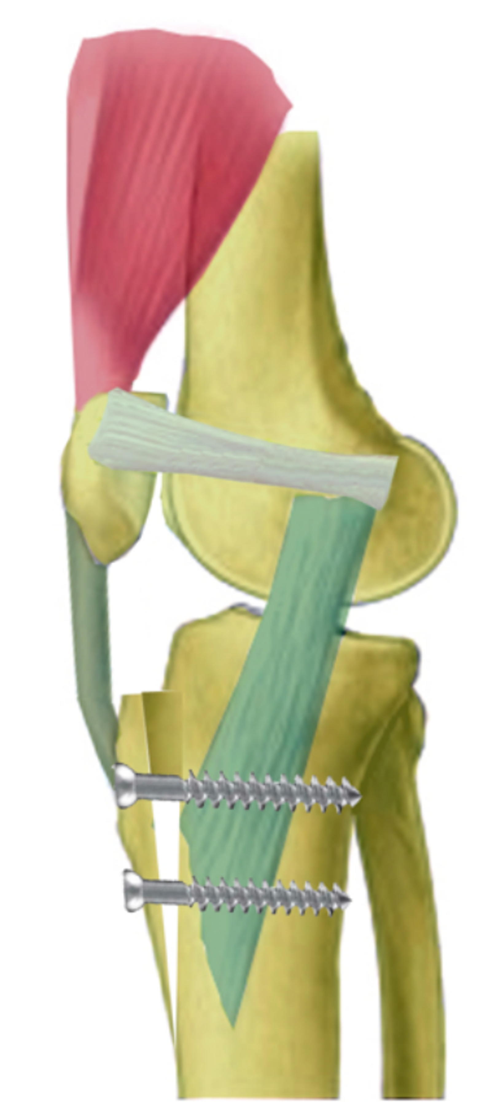 Stabilisation de la rotule — illustration 12