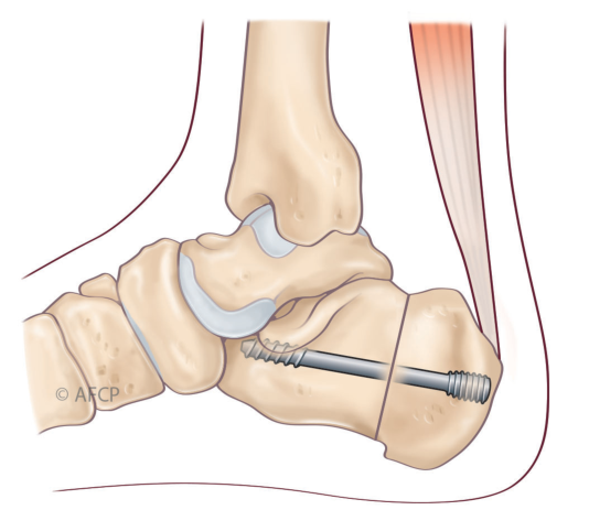 Haglund — illustration 5