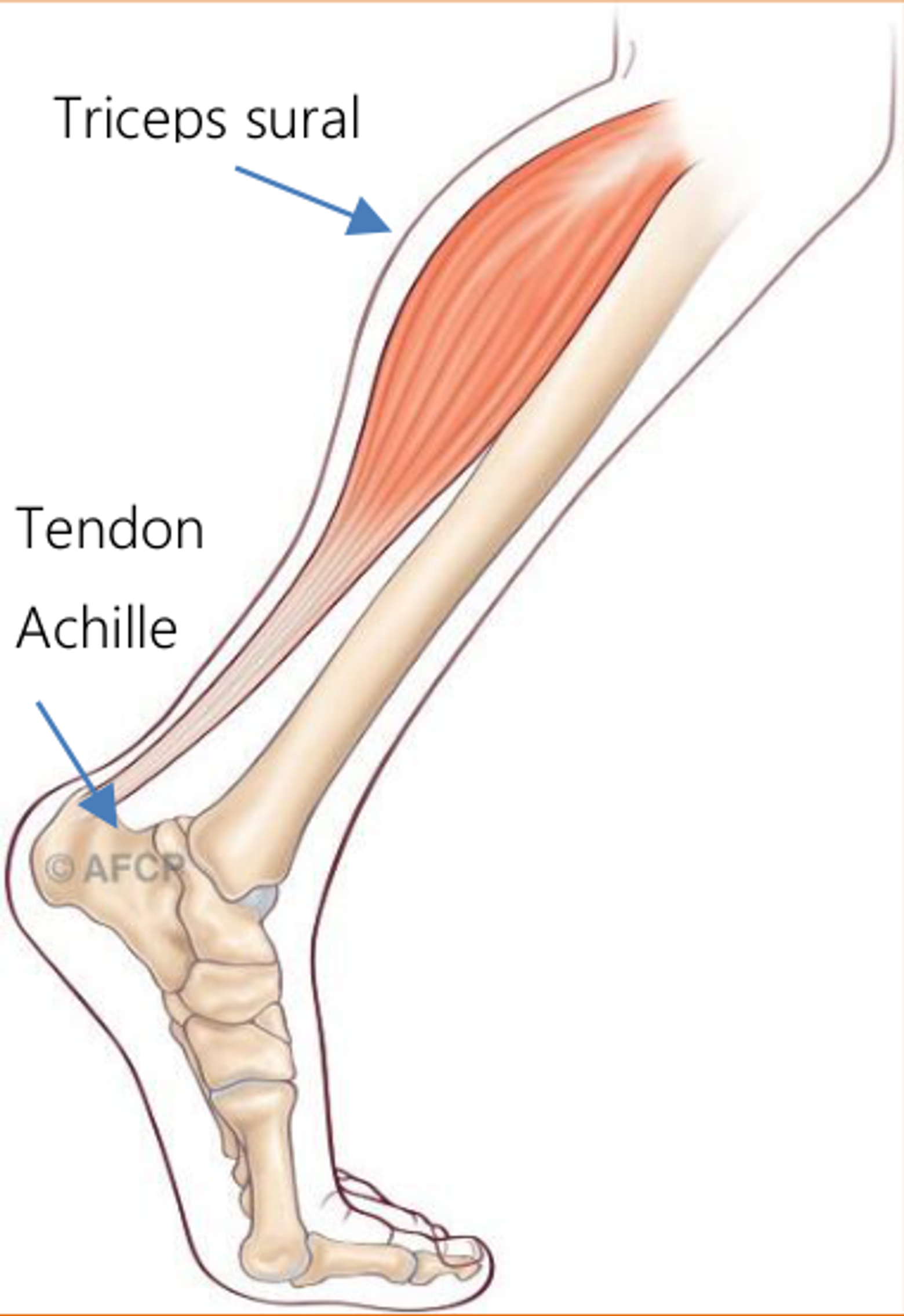 Tendinopathie d'Achille — illustration 1