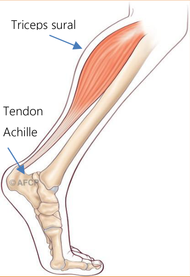 Tendinopathie d'Achille — illustration 1