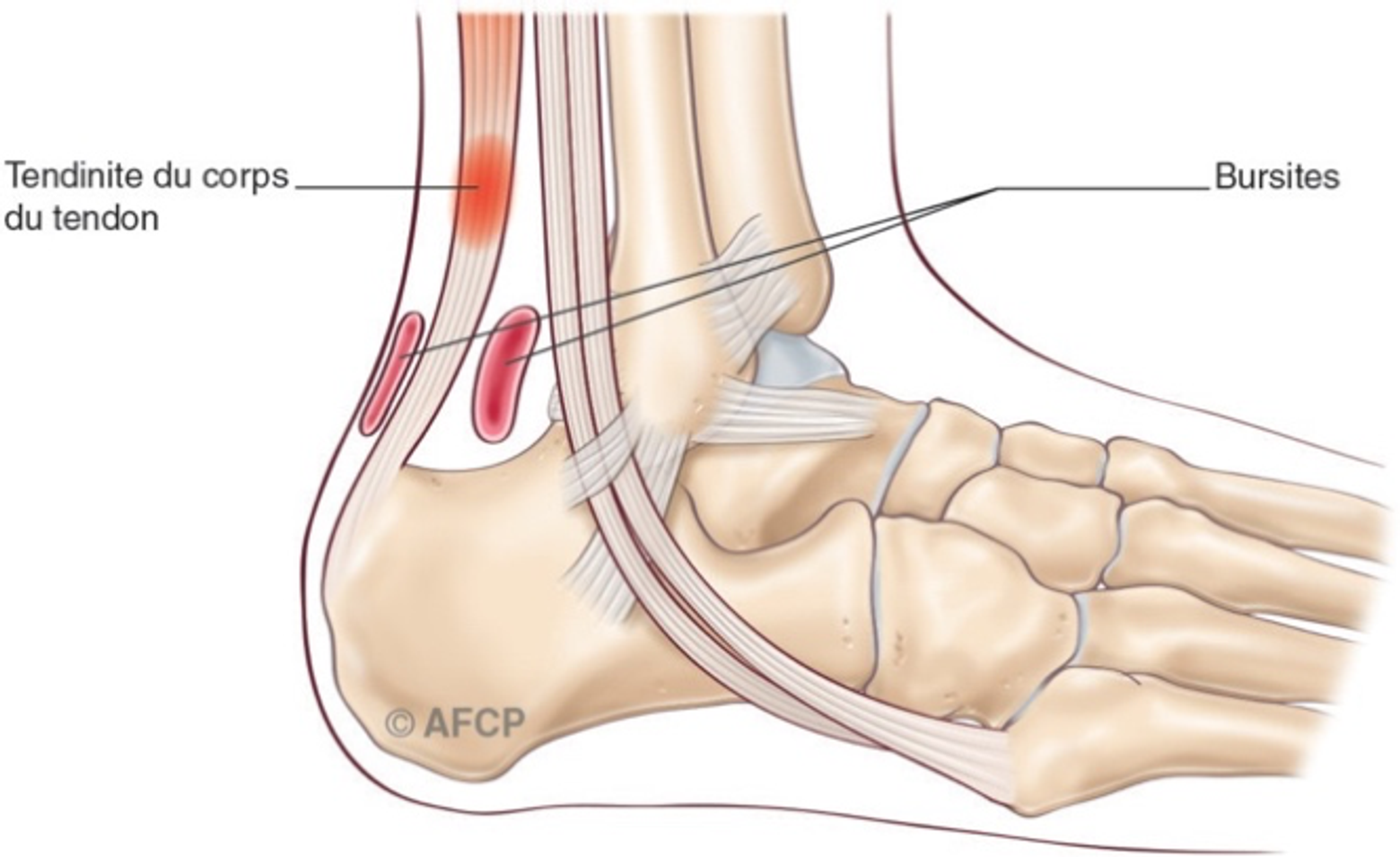 Haglund — illustration 2