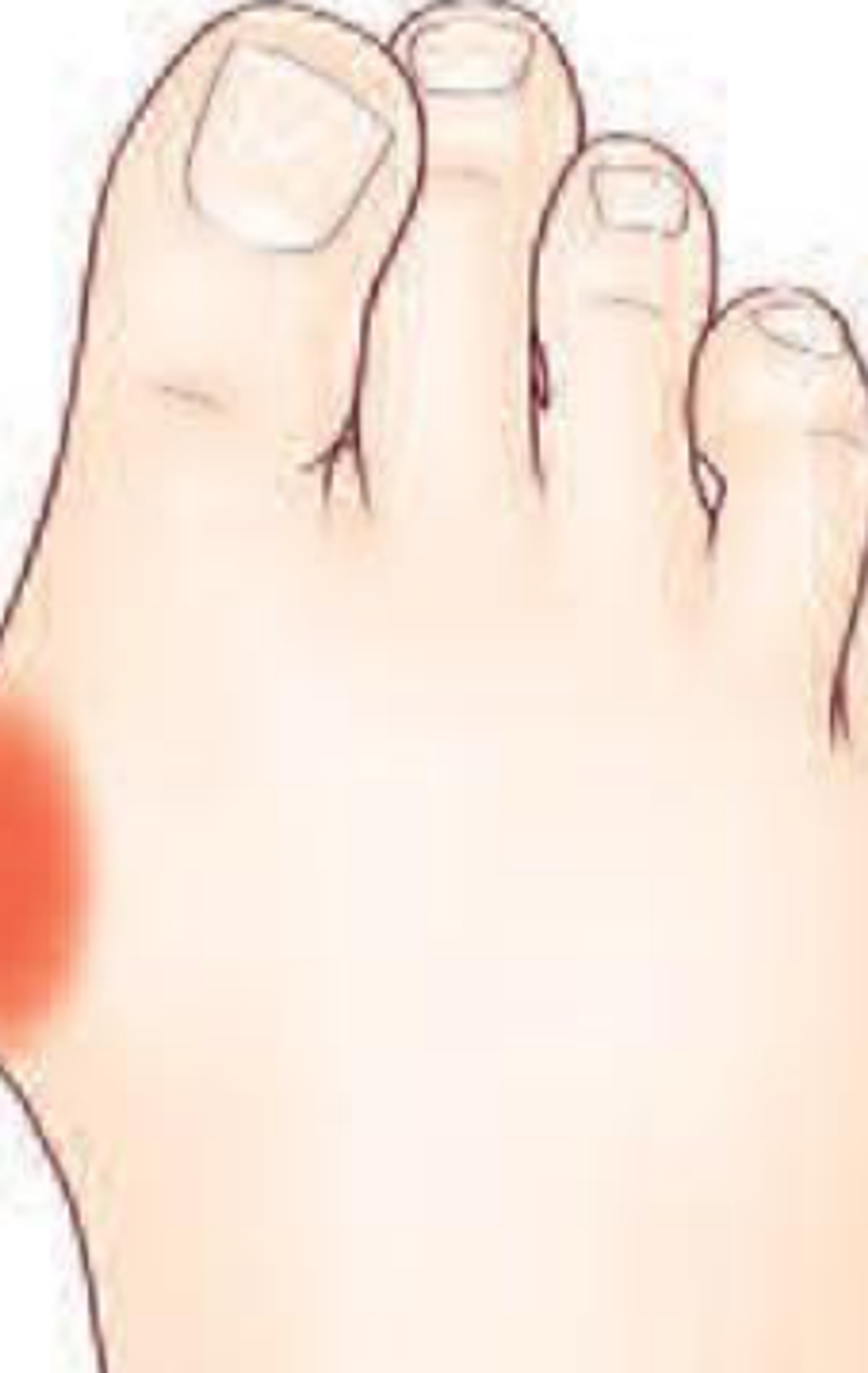 Hallux valgus — illustration 1