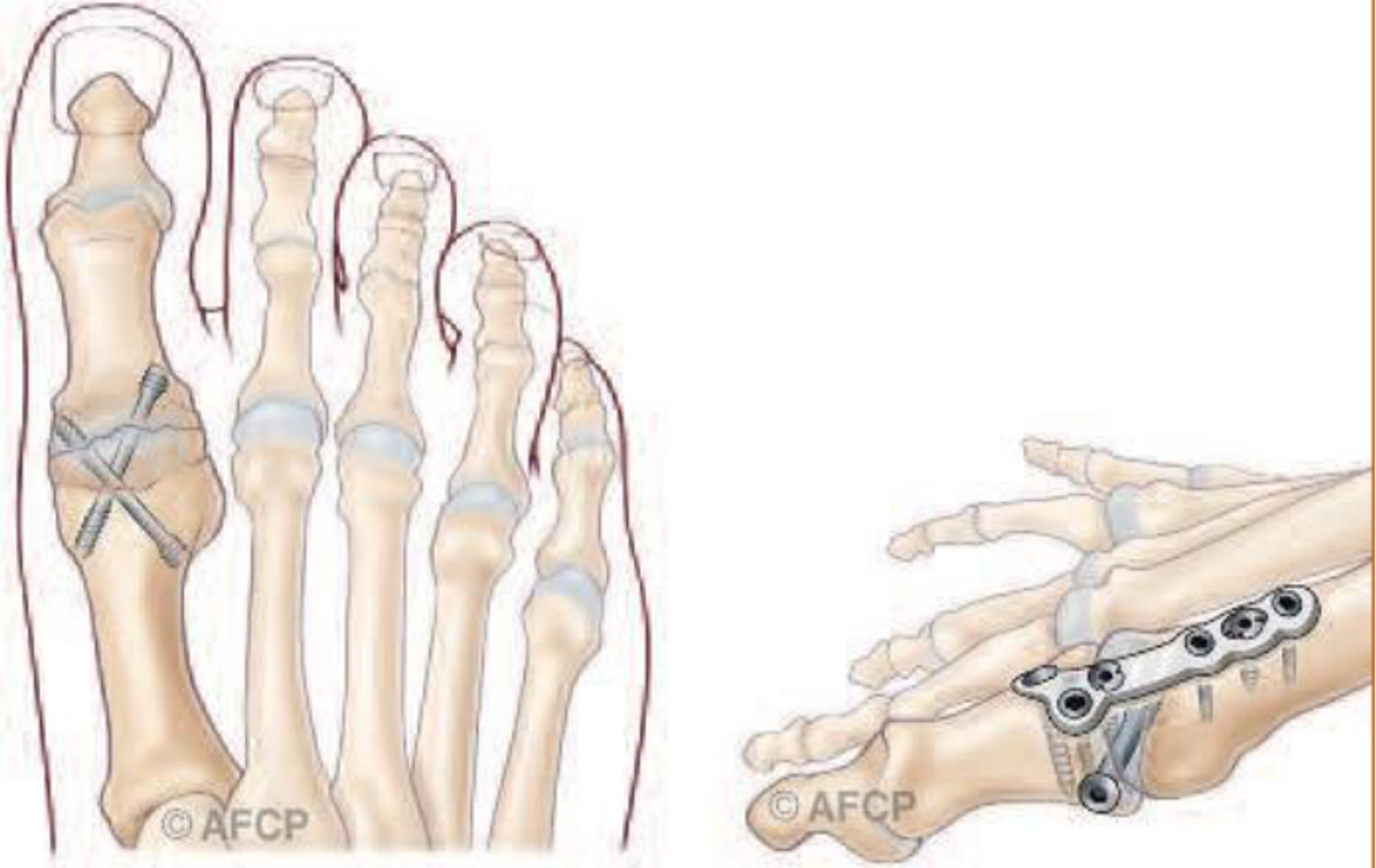 Hallux valgus — illustration 4