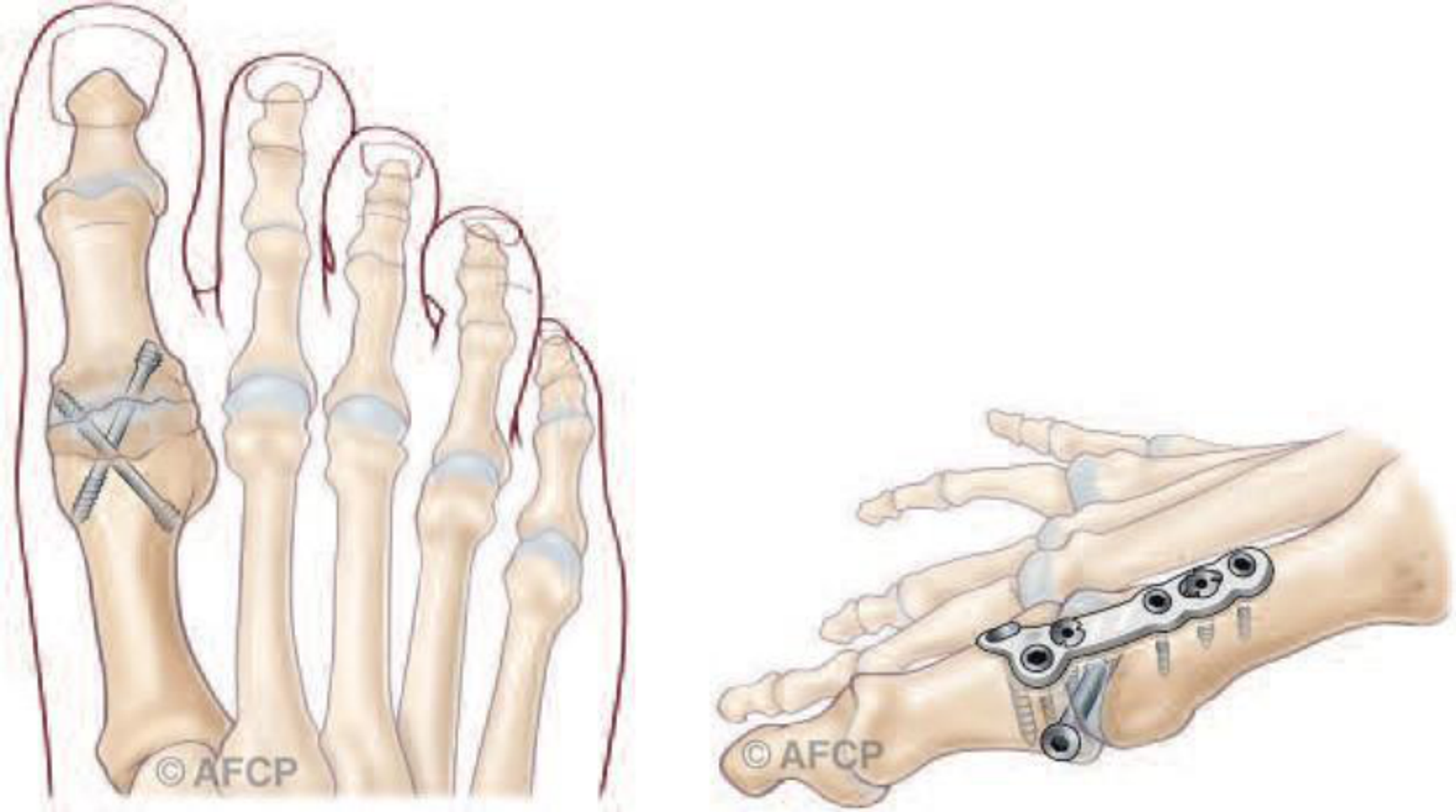 Hallux rigidus — illustration 3