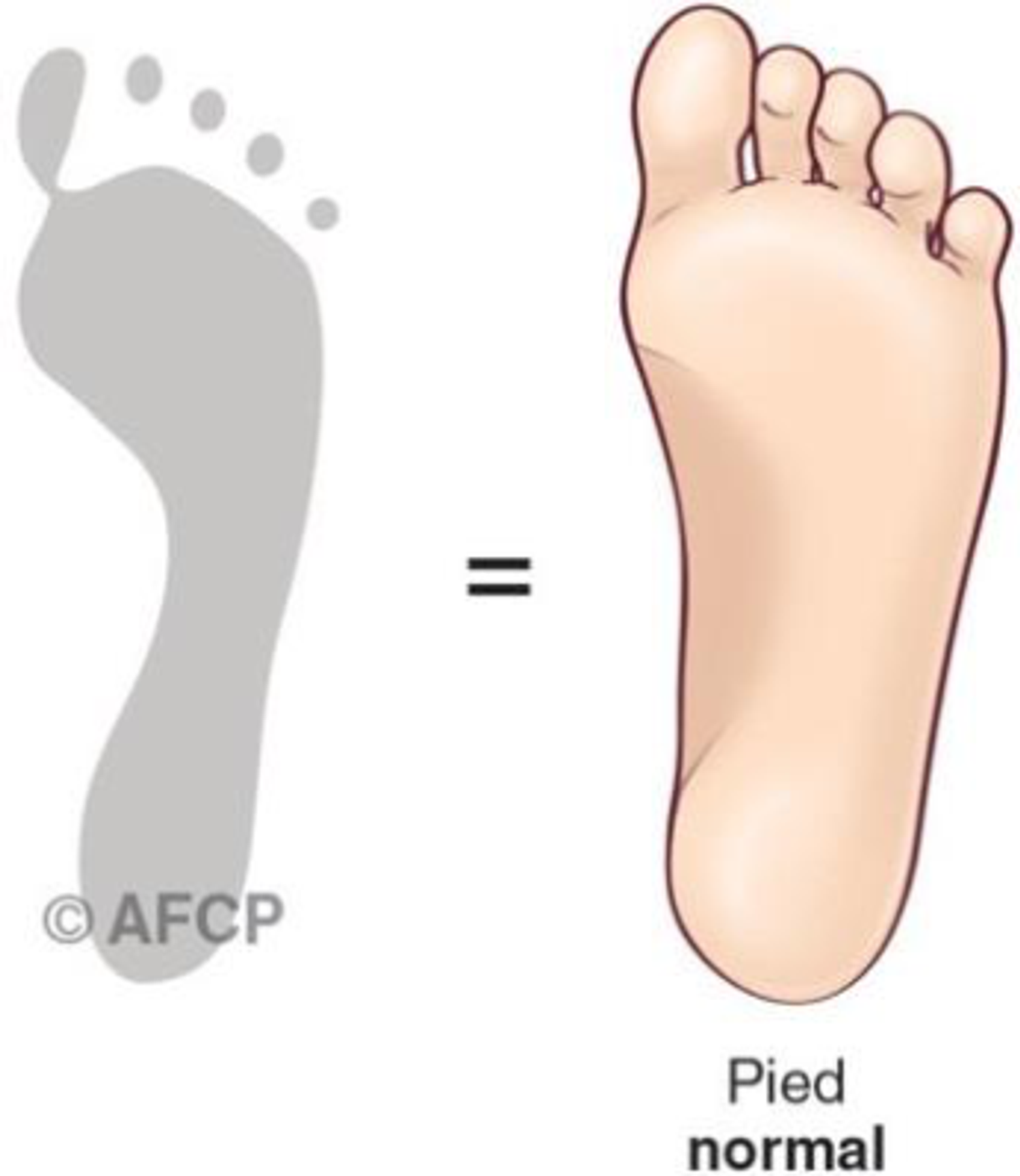 Pied creux — illustration 6