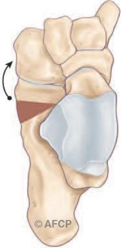 Pied plat — illustration 6