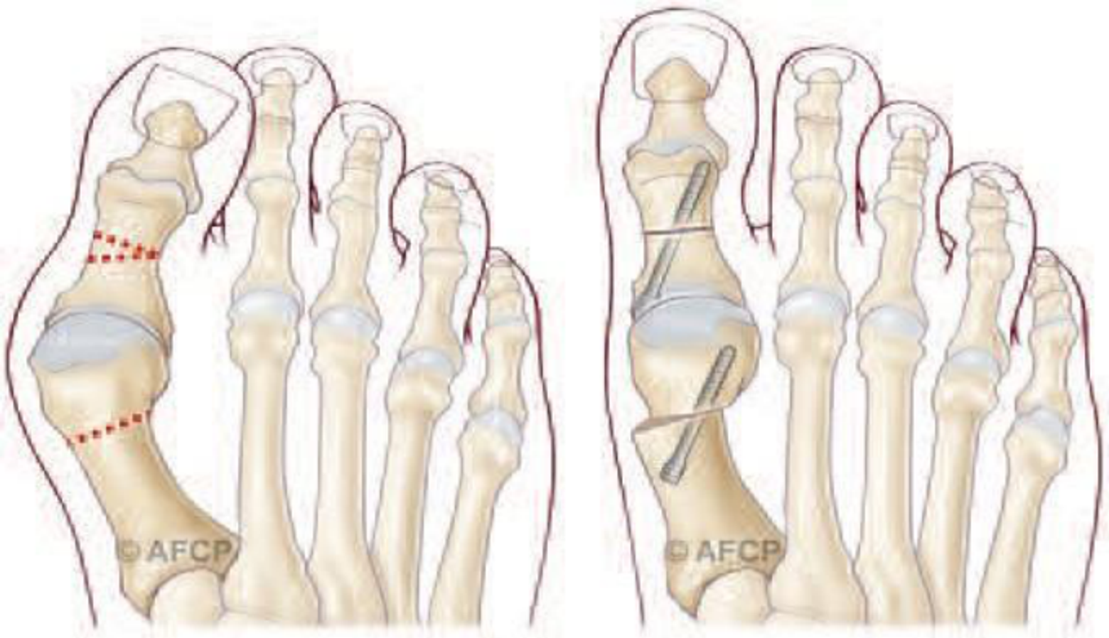 Hallux valgus — illustration 3
