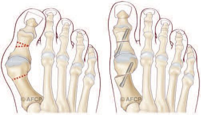 Hallux valgus — illustration 3