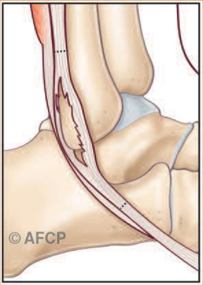 Tendons fibulaires — illustration 2