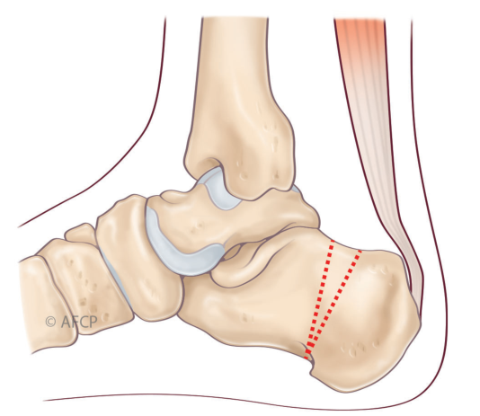 Haglund — illustration 3