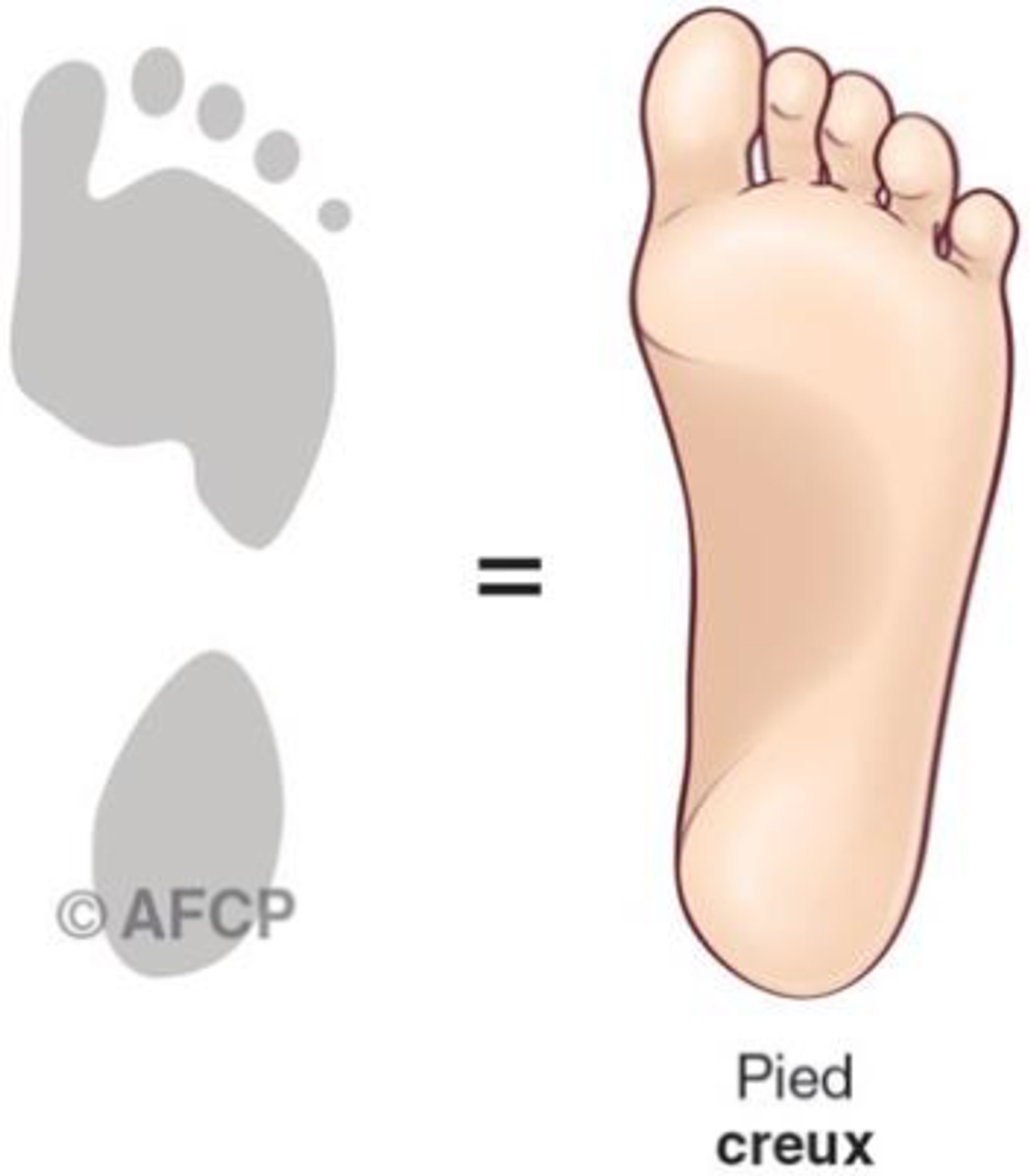Pied creux — illustration 5