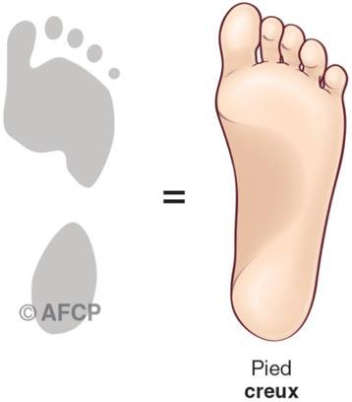 Pied creux — illustration 5