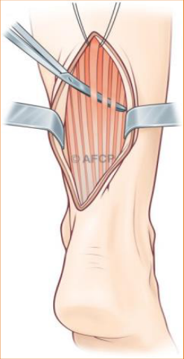 Tendinopathie d'Achille — illustration 3