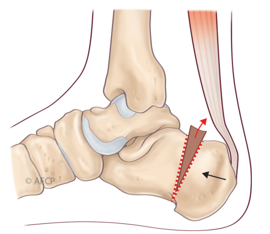 Haglund — illustration 4