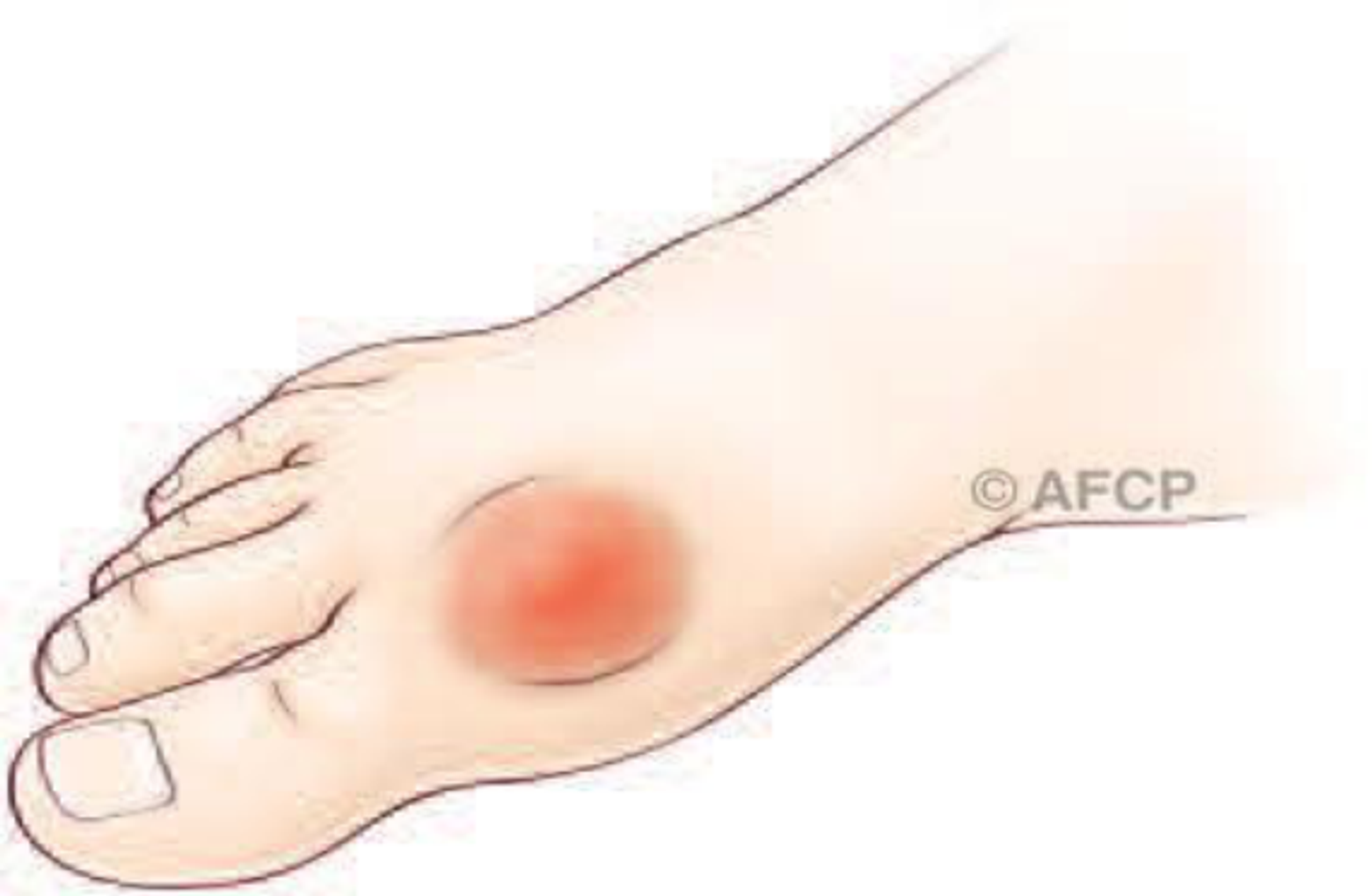 Hallux rigidus — illustration 2