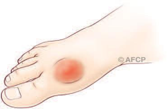Hallux rigidus — illustration 2
