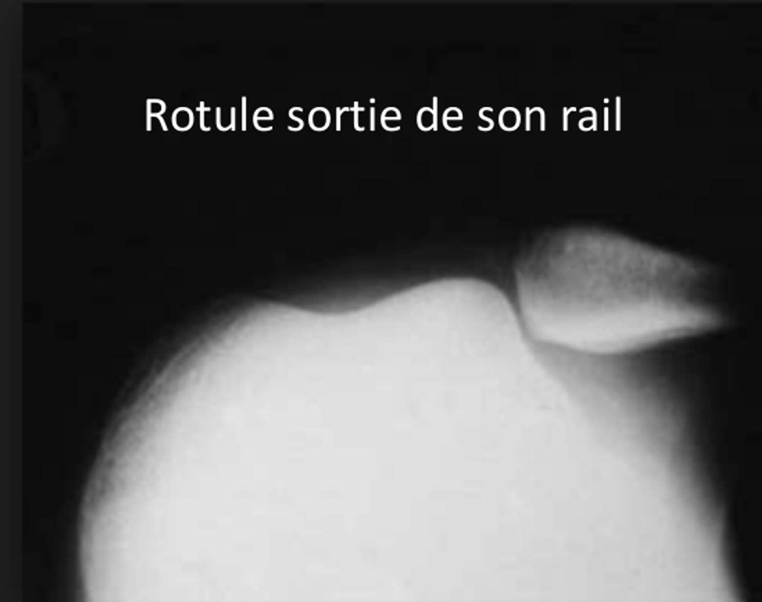 Stabilisation de la rotule — illustration 7