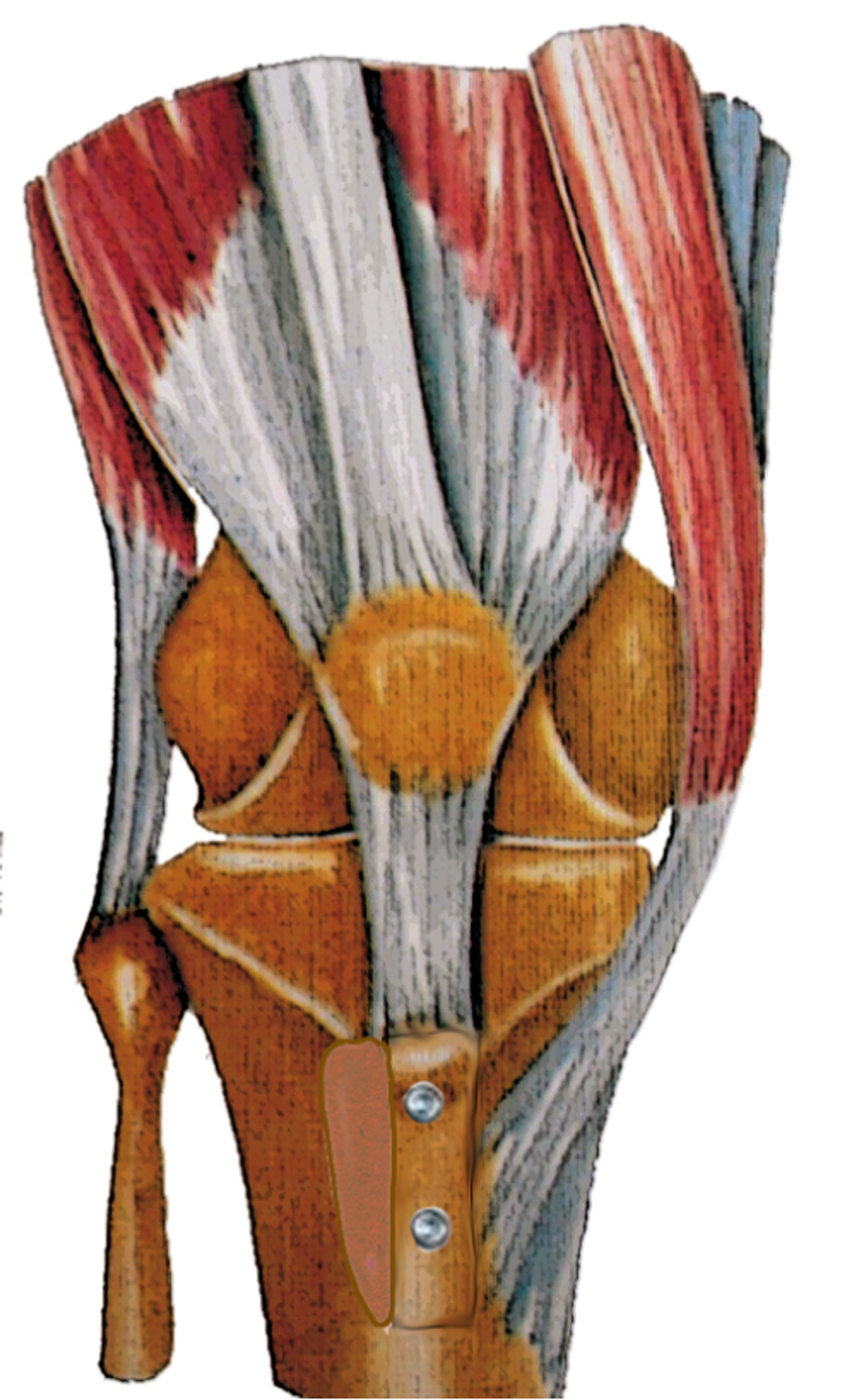 Stabilisation de la rotule — illustration 11