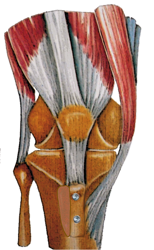 Stabilisation de la rotule — illustration 11