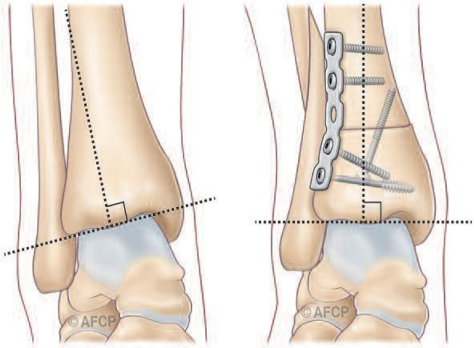 Arthrodèse de cheville — illustration 5