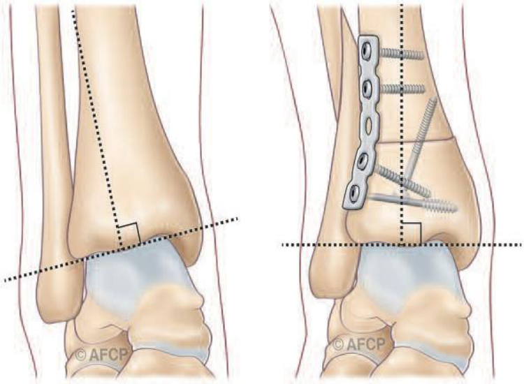 Arthrodèse de cheville — illustration 5