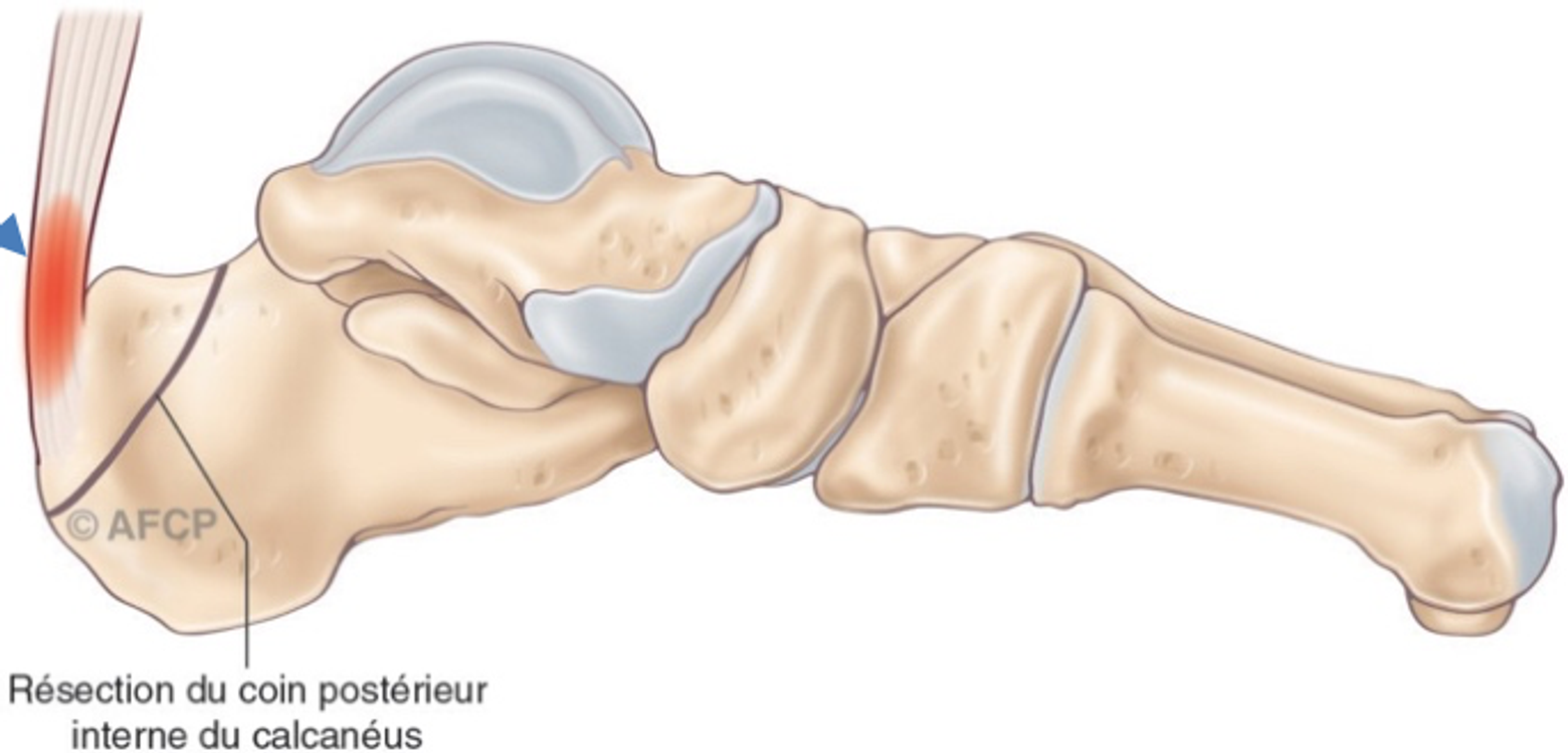 Haglund — illustration 6