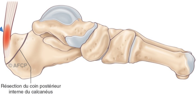 Haglund — illustration 6