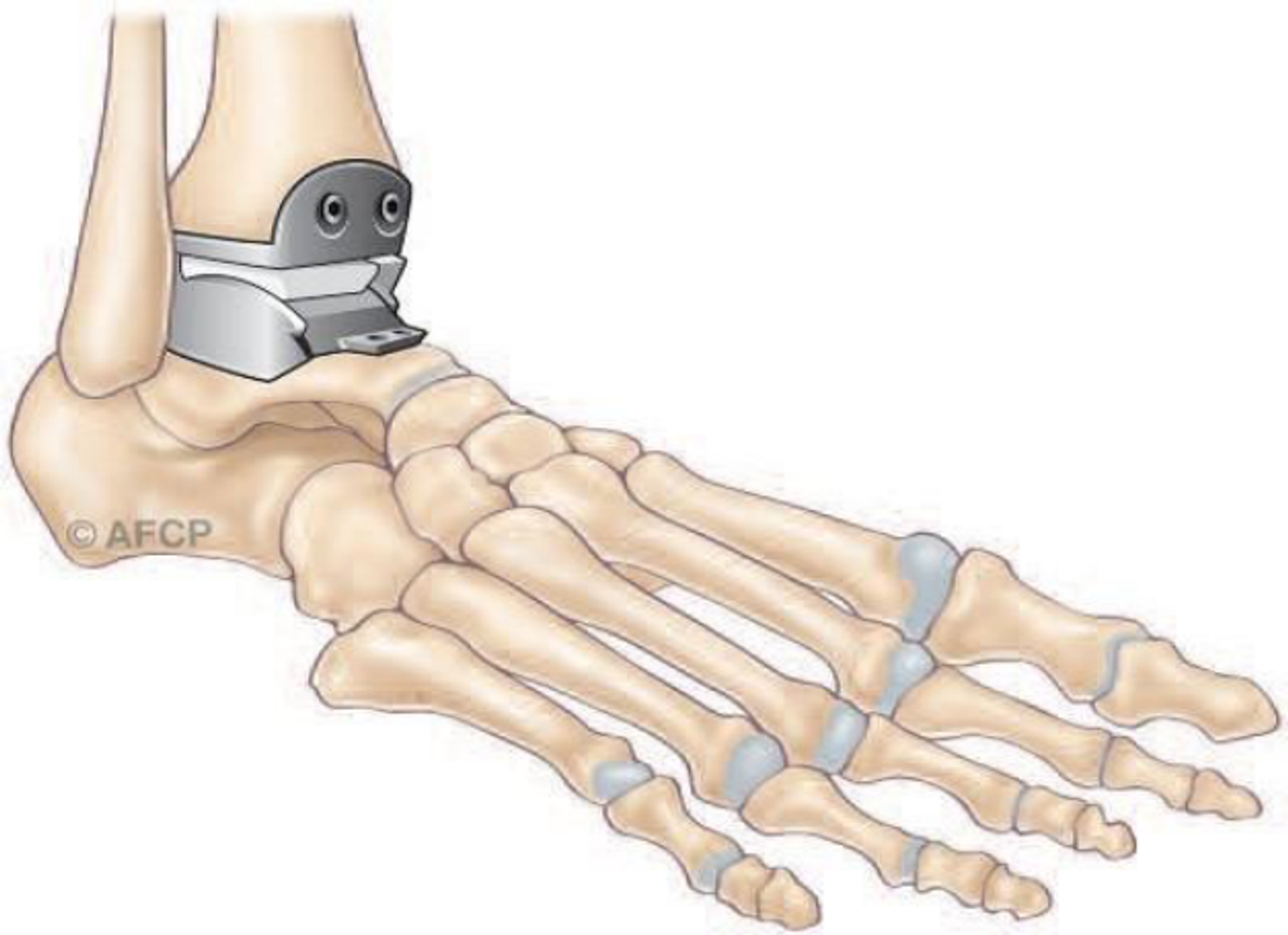 Arthrodèse de cheville — illustration 6