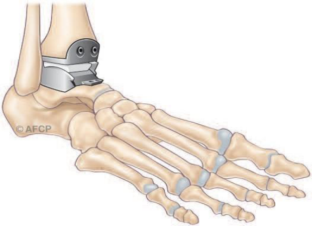 Arthrodèse de cheville — illustration 6