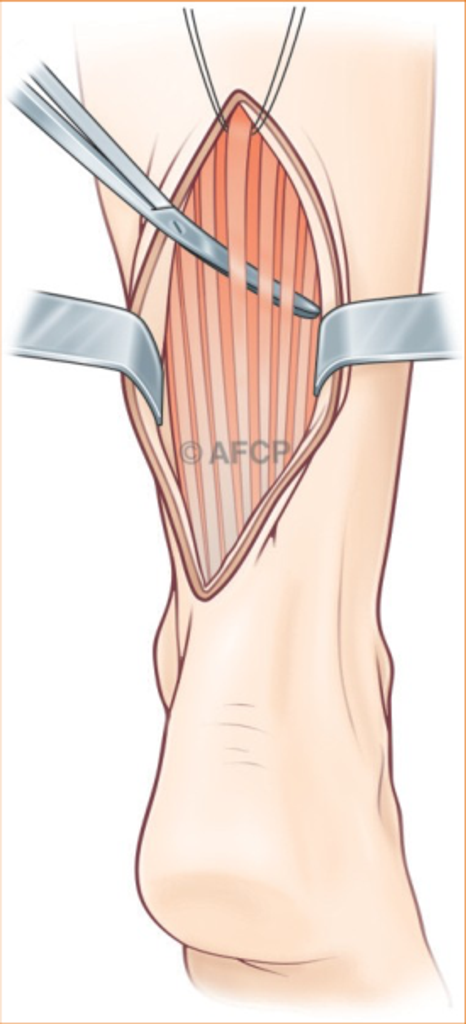 Haglund — illustration 7