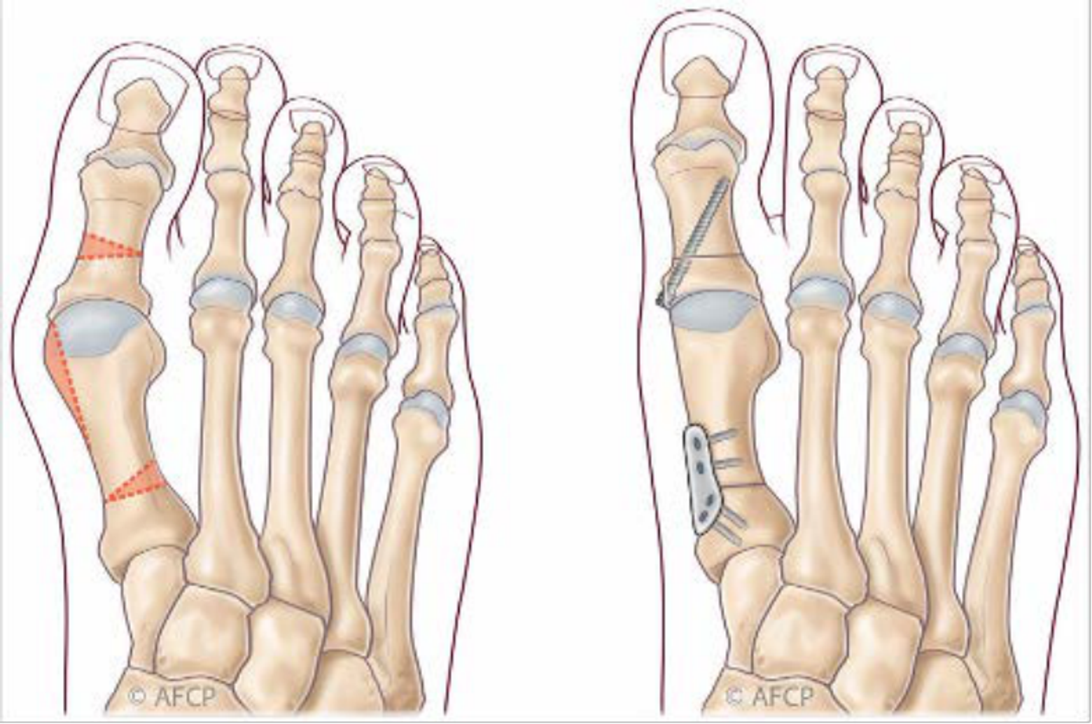 Hallux valgus — illustration 5