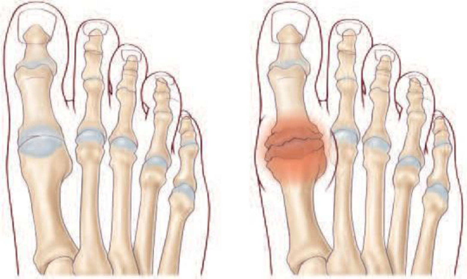 Hallux rigidus — illustration 1