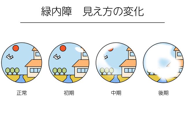 緑内障の見え方の変化|正常・初期・中期・後期の4段階比較図