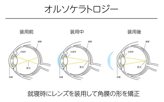 オルソケラトロジーの治療の仕組み