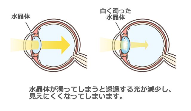 白内障のメカニズム|正常な水晶体と白く濁った水晶体の比較図