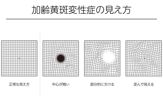加齢黄斑変性症の見え方|正常・中心が暗い・部分的に欠ける・歪んで見える の4パターン