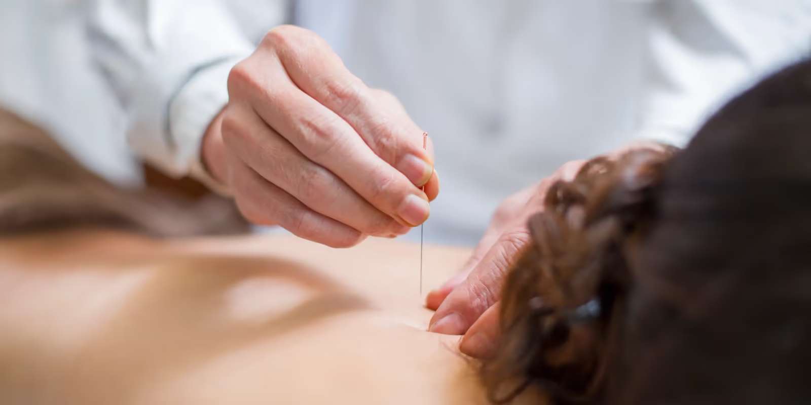 A practitioner’s hand placing a fine acupuncture needle in the upper back of a patient lying face down