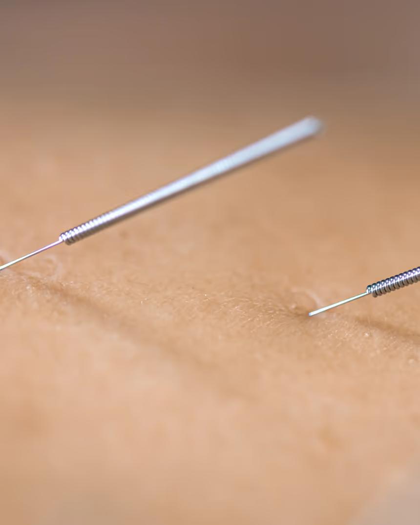 A close-up of acupuncture needles placed during treatment