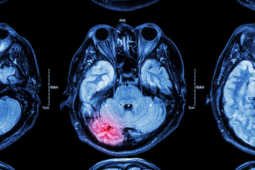 Image Understanding Traumatic Brain Injury (TBI) Claims: Seeking Compensation After a Serious Accident in New Jersey