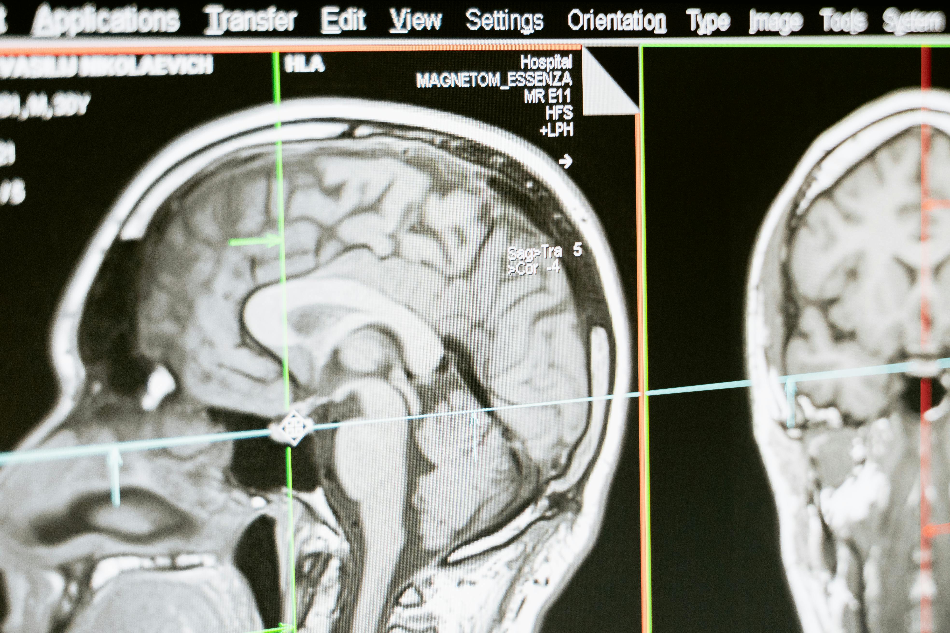 Person experiencing vertigo and imbalance related to inner ear disorder